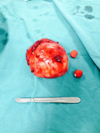 Retroperitoneal kitle(karın içi 12 cm çaplı kitle)